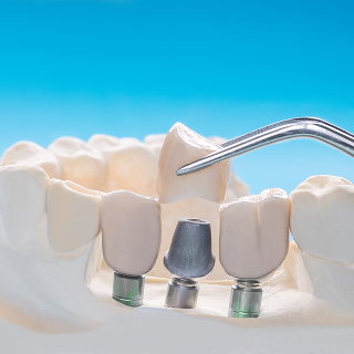 dental implants in Fargo, ND