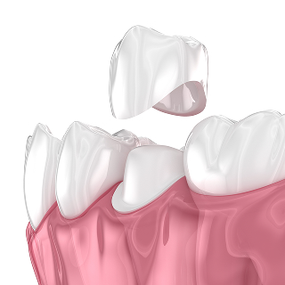dental crowns