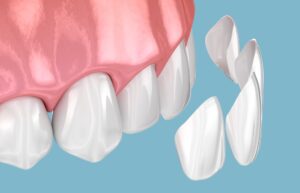 3D Model of Porcelain Veneer Placement