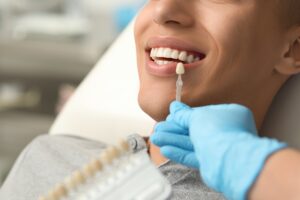 patient having teeth color matched for porcelain veneers